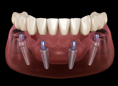Dentures or implants
